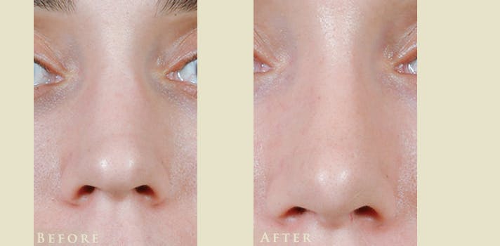 Aesthetic Rhinoplasty Before & After Gallery - Patient 419504 - Image 1
