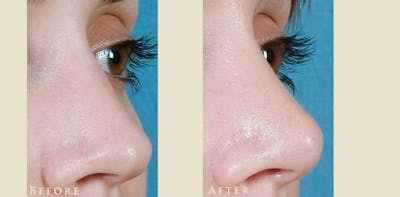 Aesthetic Rhinoplasty Before & After Gallery - Patient 419504 - Image 2