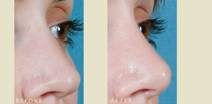 Aesthetic Rhinoplasty Before & After Gallery - Patient 419504 - Image 2
