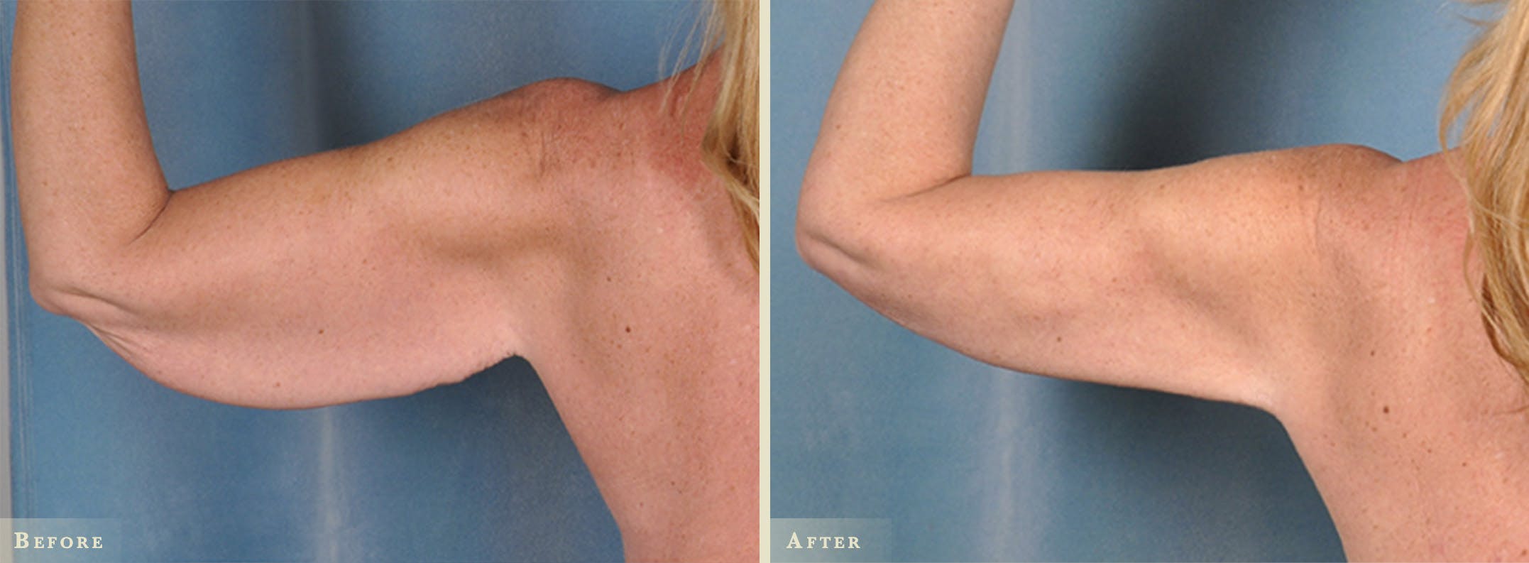 Arm Lift Before & After Gallery - Patient 396883 - Image 1