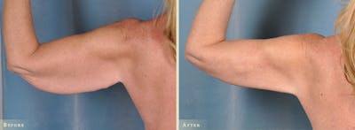 Arm Lift Before & After Gallery - Patient 396883 - Image 1