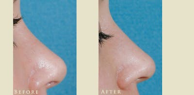 Aesthetic Rhinoplasty Before & After Gallery - Patient 419504 - Image 3