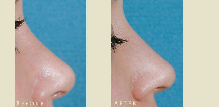 Aesthetic Rhinoplasty Before & After Gallery - Patient 419504 - Image 3