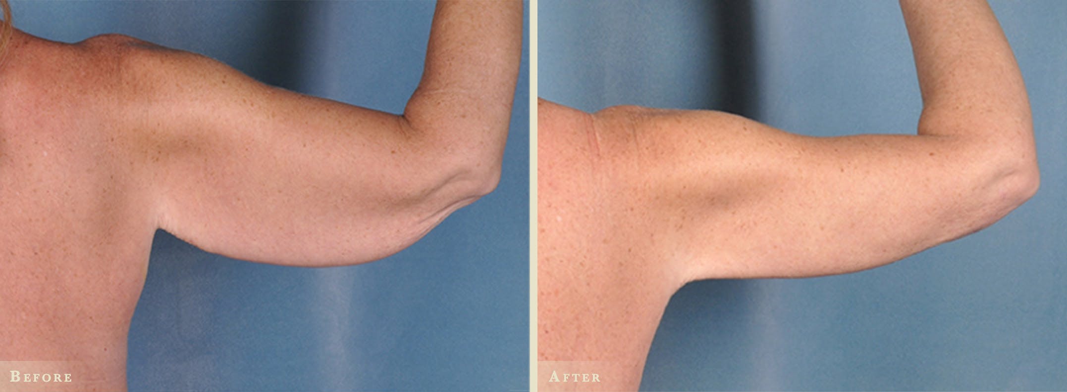 Arm Lift Before & After Gallery - Patient 396883 - Image 2