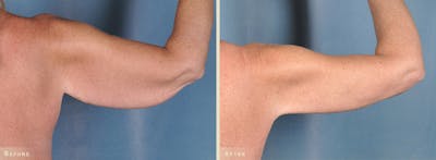 Arm Lift Before & After Gallery - Patient 396883 - Image 2