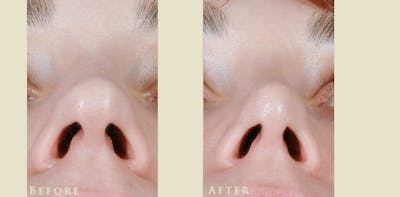Aesthetic Rhinoplasty Before & After Gallery - Patient 419504 - Image 4