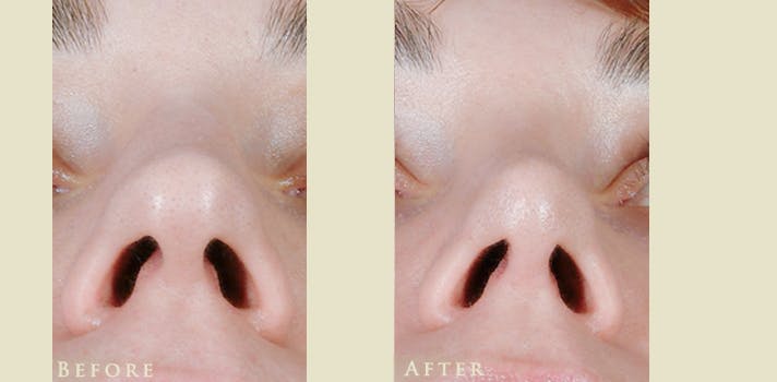Aesthetic Rhinoplasty Before & After Gallery - Patient 419504 - Image 4