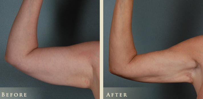 Arm Lift Before & After Gallery - Patient 176006 - Image 1