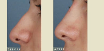 Aesthetic Rhinoplasty Before & After Gallery - Patient 114532 - Image 1