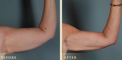 Arm Lift Before & After Gallery - Patient 176006 - Image 2