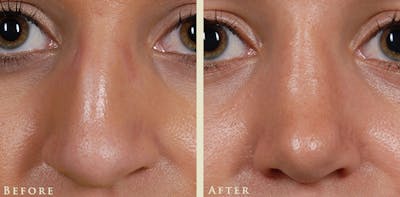 Aesthetic Rhinoplasty Before & After Gallery - Patient 345615 - Image 1