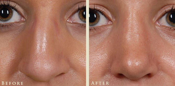 Aesthetic Rhinoplasty Before & After Gallery - Patient 345615 - Image 1