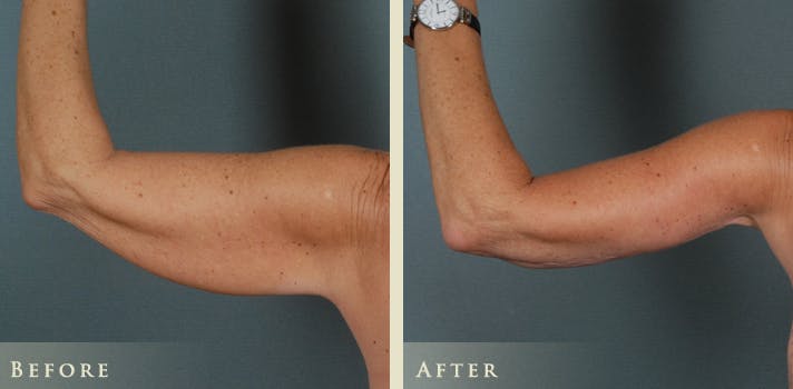 Arm Lift Before & After Gallery - Patient 124836 - Image 1