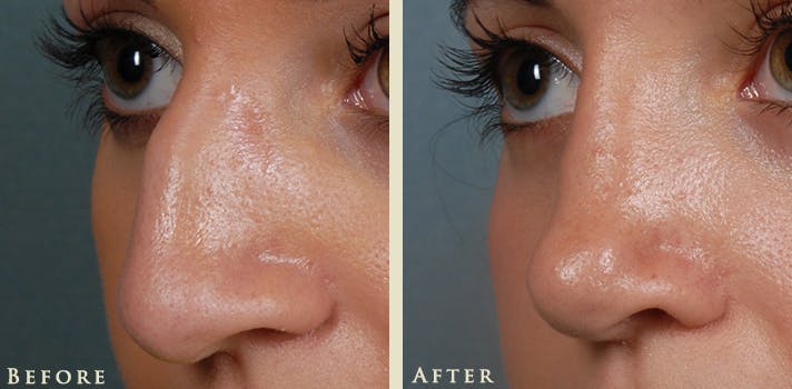 Aesthetic Rhinoplasty Before & After Gallery - Patient 345615 - Image 2