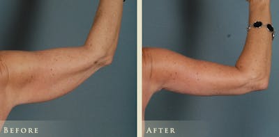 Arm Lift Before & After Gallery - Patient 124836 - Image 2