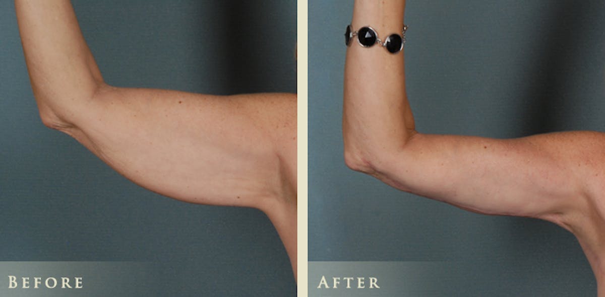 Arm Lift Before & After Gallery - Patient 124836 - Image 3
