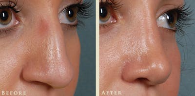 Aesthetic Rhinoplasty Before & After Gallery - Patient 345615 - Image 3