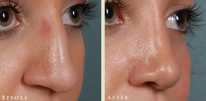 Aesthetic Rhinoplasty Before & After Gallery - Patient 345615 - Image 3