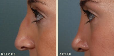 Aesthetic Rhinoplasty Before & After Gallery - Patient 345615 - Image 4