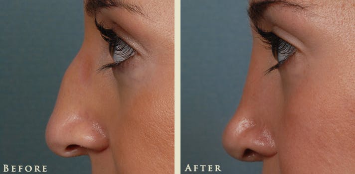 Aesthetic Rhinoplasty Before & After Gallery - Patient 345615 - Image 4
