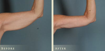 Arm Lift Before & After Gallery - Patient 124836 - Image 4