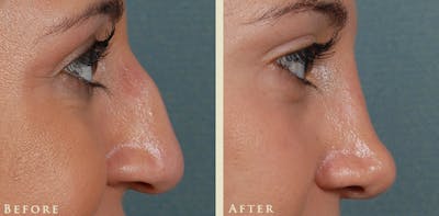 Aesthetic Rhinoplasty Before & After Gallery - Patient 345615 - Image 5