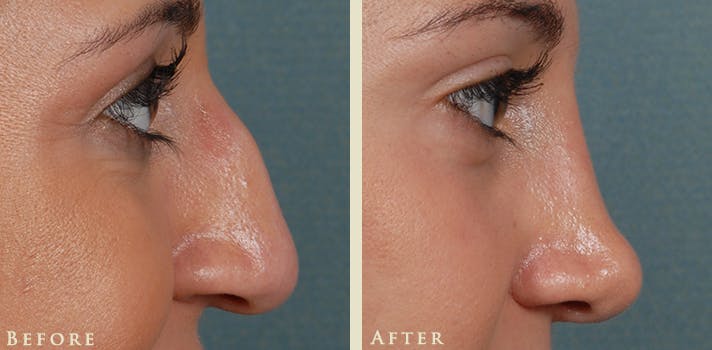 Aesthetic Rhinoplasty Before & After Gallery - Patient 345615 - Image 5