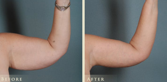 Arm Lift Before & After Gallery - Patient 656803 - Image 1