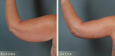 Arm Lift Before & After Gallery - Patient 656803 - Image 2