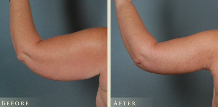 Arm Lift Before & After Gallery - Patient 656803 - Image 2