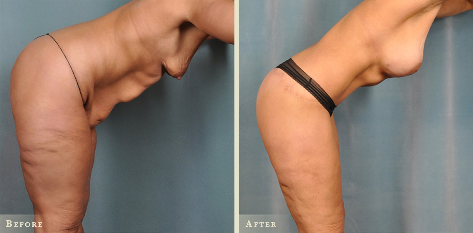 Body Lift Before & After Gallery - Patient 342503 - Image 1