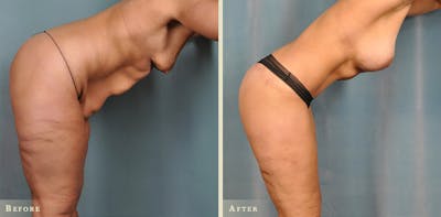 Body Lift Before & After Gallery - Patient 342503 - Image 1