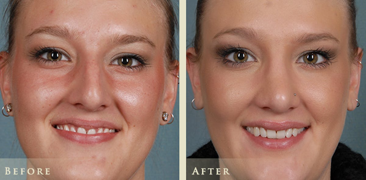 Aesthetic Rhinoplasty Before & After Gallery - Patient 347125 - Image 1