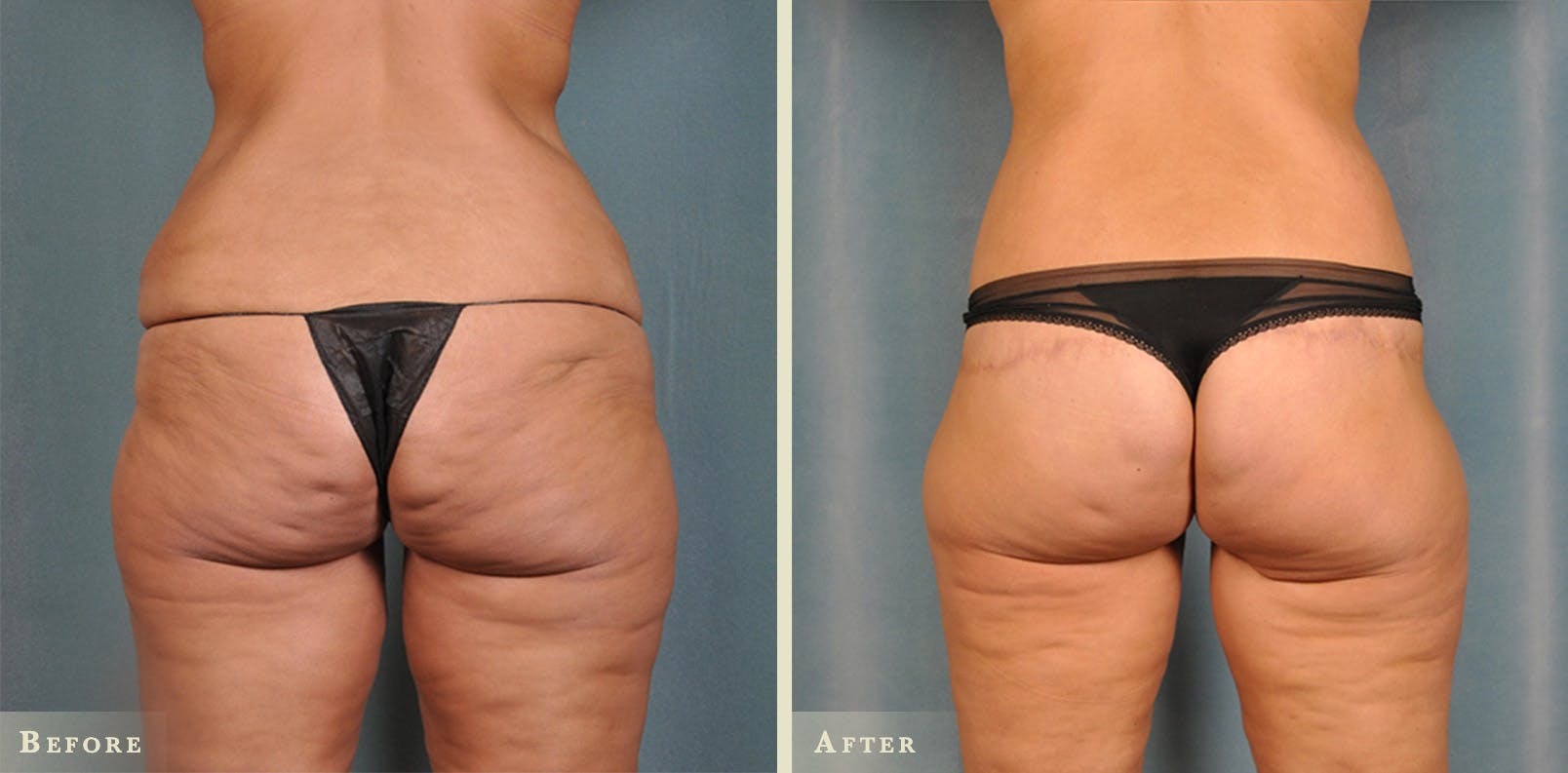 Body Lift Before & After Gallery - Patient 342503 - Image 2