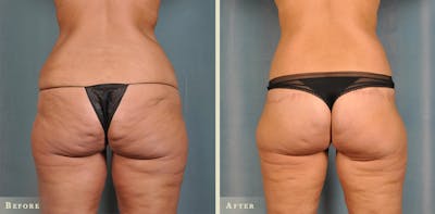 Body Lift Before & After Gallery - Patient 342503 - Image 2