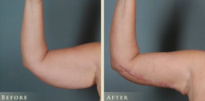 Arm Lift Before & After Gallery - Patient 656803 - Image 3