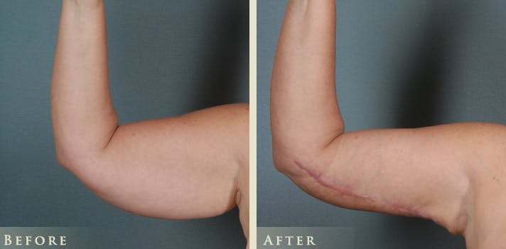Arm Lift Before & After Gallery - Patient 656803 - Image 3