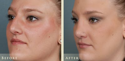 Aesthetic Rhinoplasty Before & After Gallery - Patient 347125 - Image 2