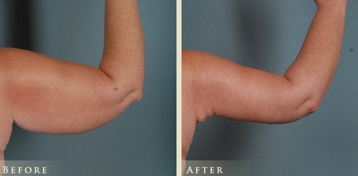 Arm Lift Before & After Gallery - Patient 656803 - Image 4