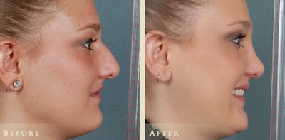 Aesthetic Rhinoplasty Before & After Gallery - Patient 347125 - Image 3