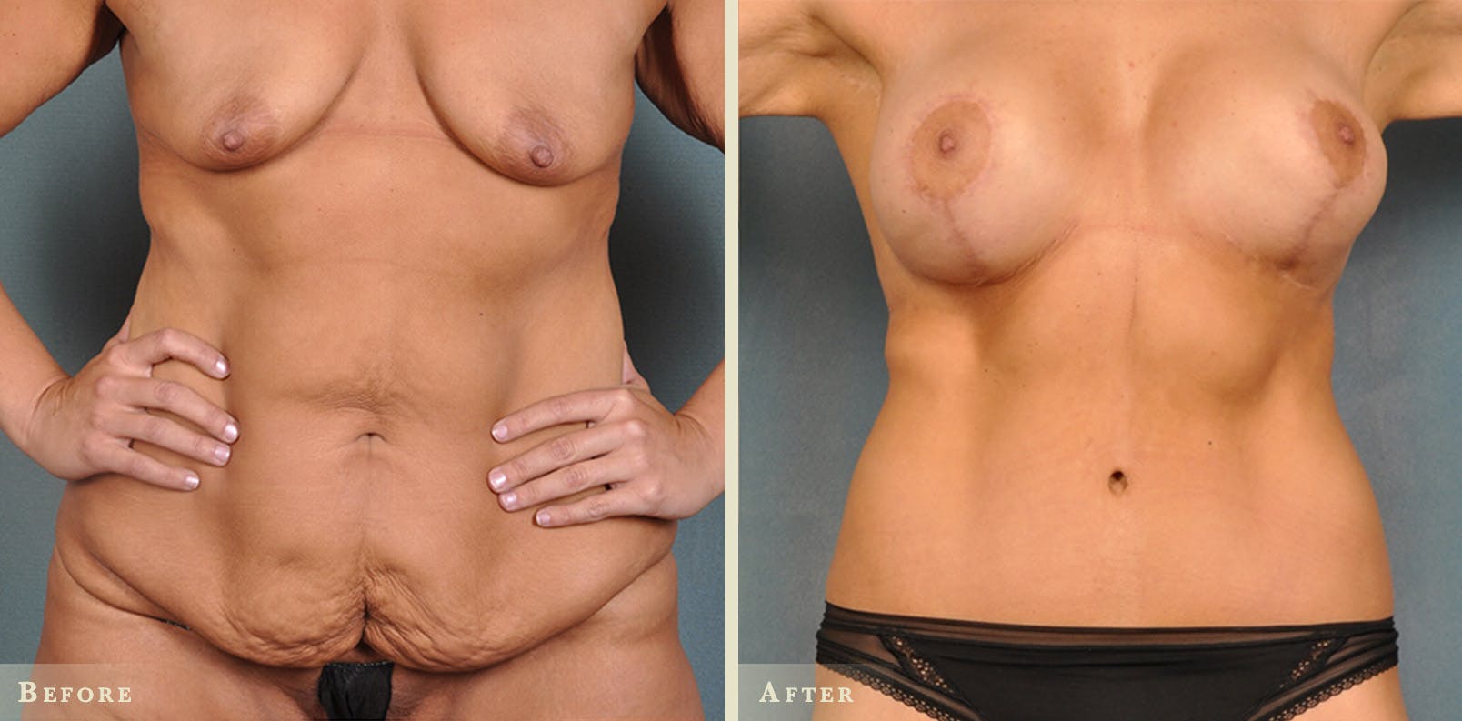 Body Lift Before & After Gallery - Patient 342503 - Image 3