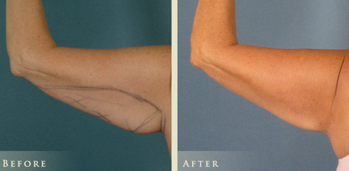 Arm Lift Before & After Gallery - Patient 425865 - Image 1