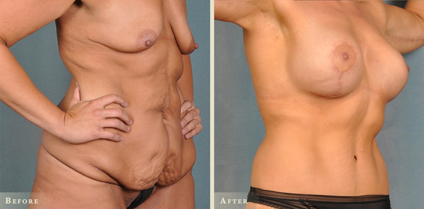 Body Lift Before & After Gallery - Patient 342503 - Image 4