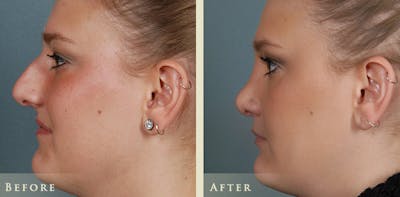 Aesthetic Rhinoplasty Before & After Gallery - Patient 347125 - Image 5