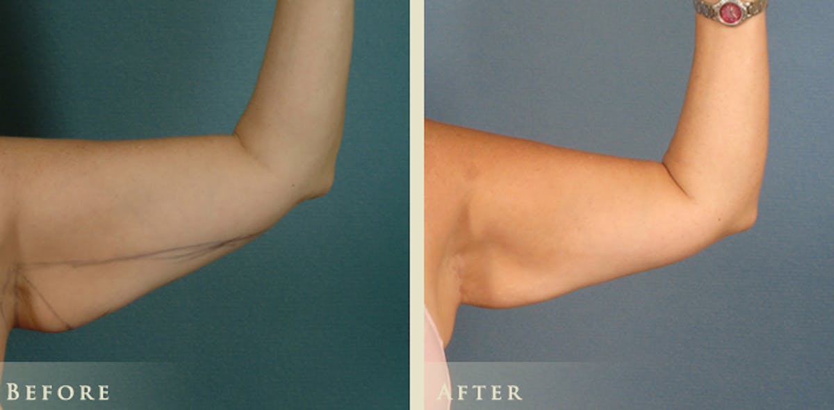 Arm Lift Before & After Gallery - Patient 425865 - Image 2