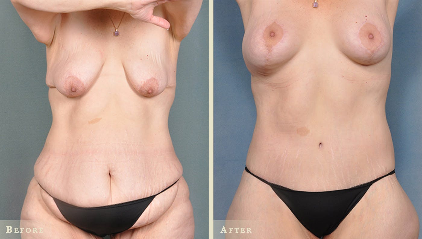 Body Lift Before & After Gallery - Patient 316573 - Image 1