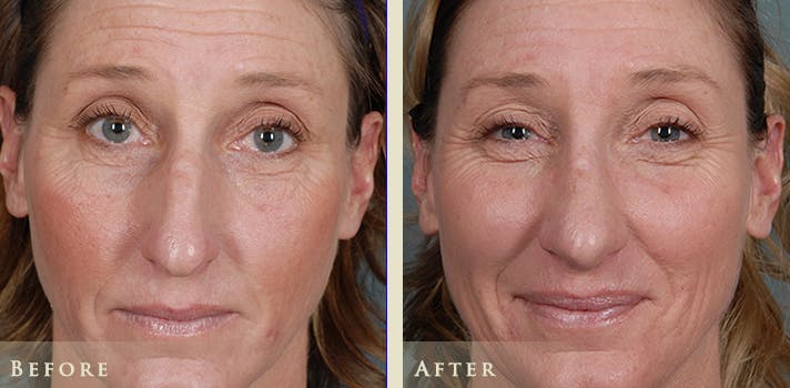 Aesthetic Rhinoplasty Before & After Gallery - Patient 333665 - Image 1