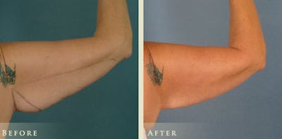 Arm Lift Before & After Gallery - Patient 425865 - Image 3