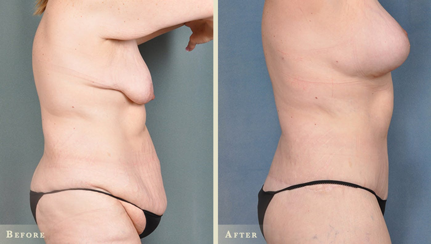 Body Lift Before & After Gallery - Patient 316573 - Image 2