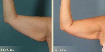 Arm Lift Before & After Gallery - Patient 425865 - Image 4